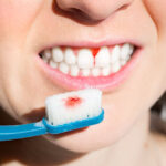 Gencive qui saigne : comment le traiter ?