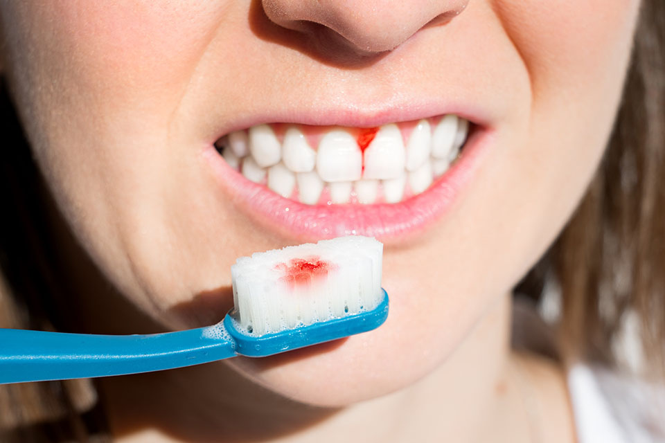 Gencive qui saigne : comment le traiter ?