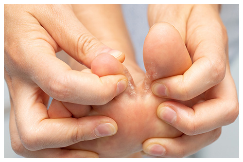 soigner efficacement un intertrigo entre les orteils